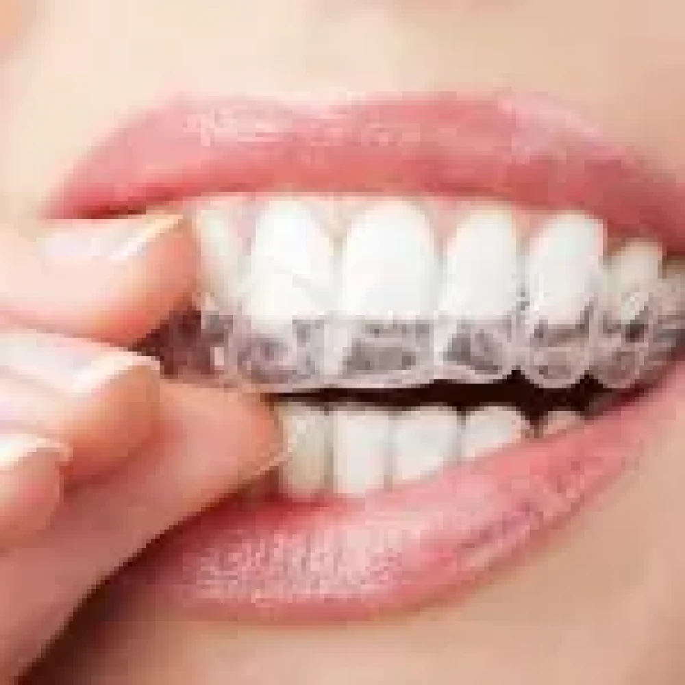 Aligner